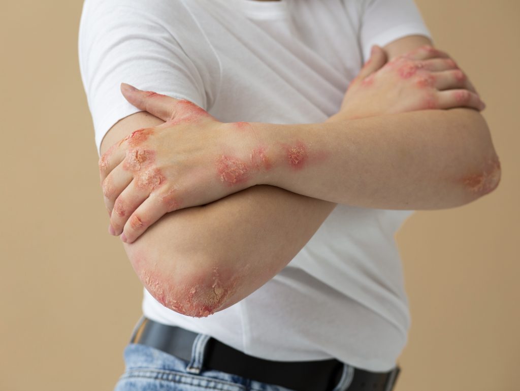 Psorijaza te ne definiše! Oslobodite se predrasuda, uživajte u letu